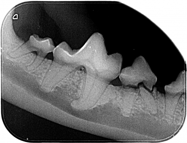 Premolar with two fractured roots below the gum line